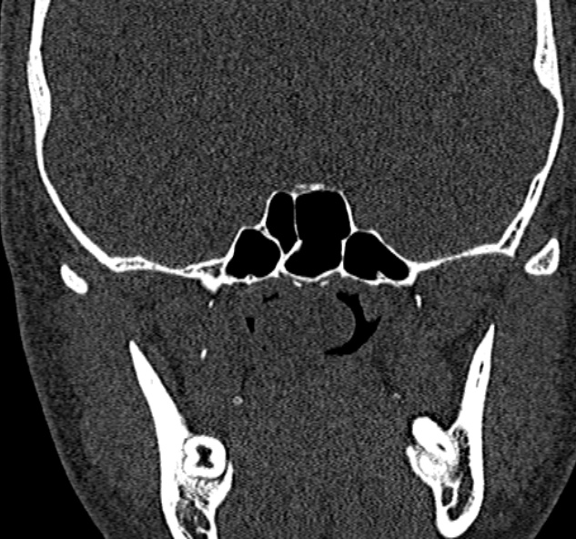 File:Antrochoanal polyp (Radiopaedia 30002-30554 Coronal bone window 68).jpg