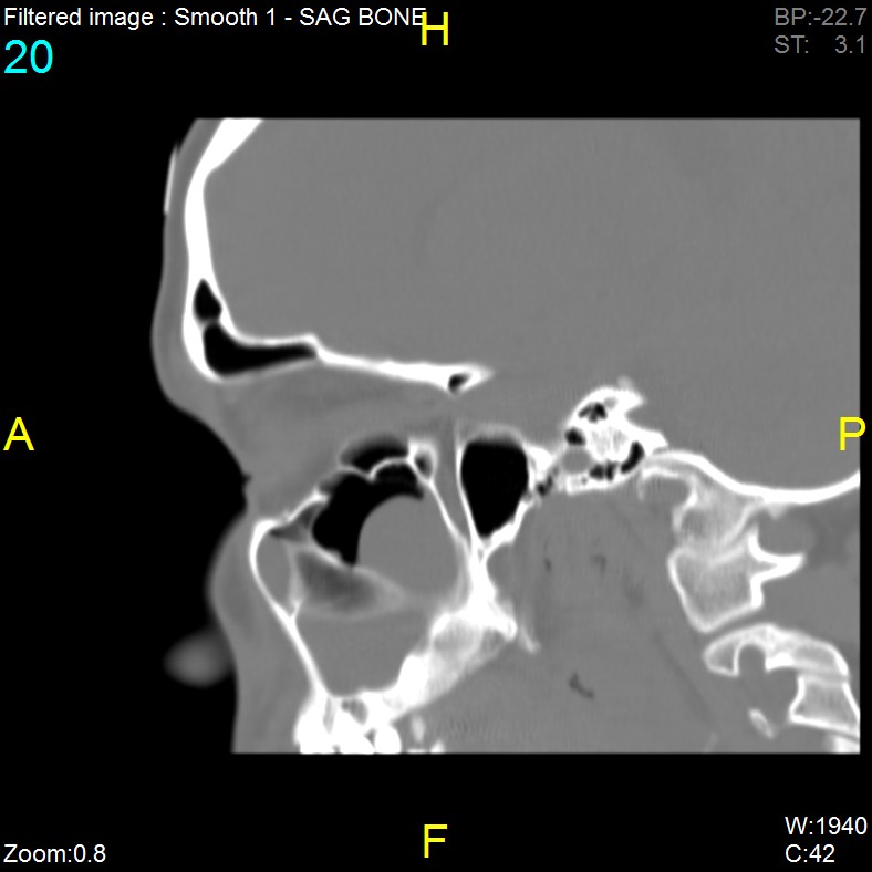 Antrochoanal polyp (Radiopaedia 65101-74094 Sagittal bone window 20).jpg