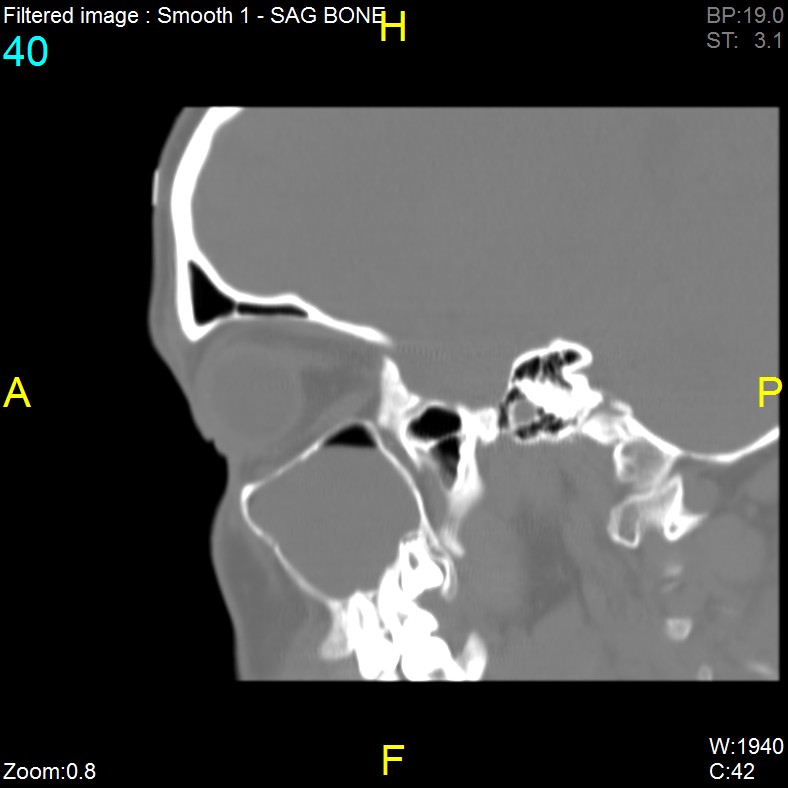 Antrochoanal polyp (Radiopaedia 65101-74094 Sagittal bone window 40).jpg