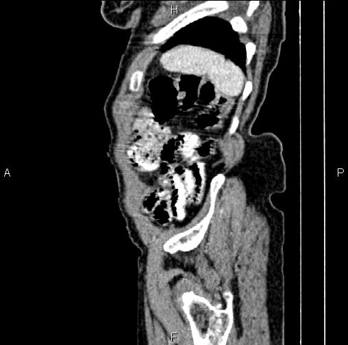 File:Aortic aneurysm and Lemmel syndrome (Radiopaedia 86499-102554 D 81).jpg