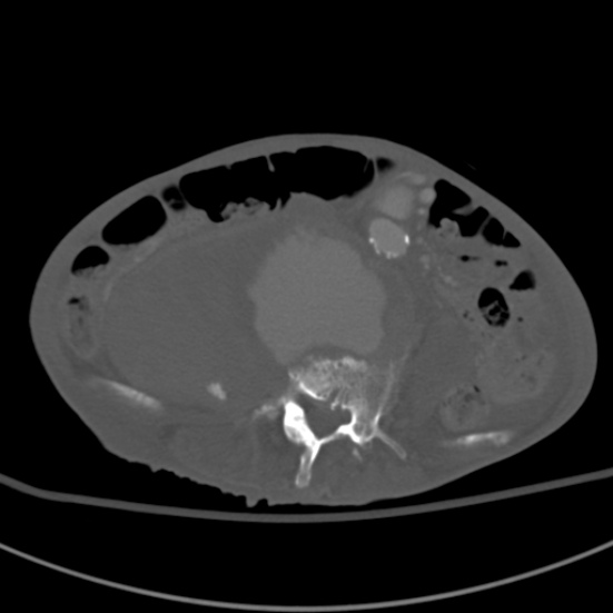 Aortic aneurysm with spinal destruction (Radiopaedia 42301-45410 Axial bone window 62).jpg