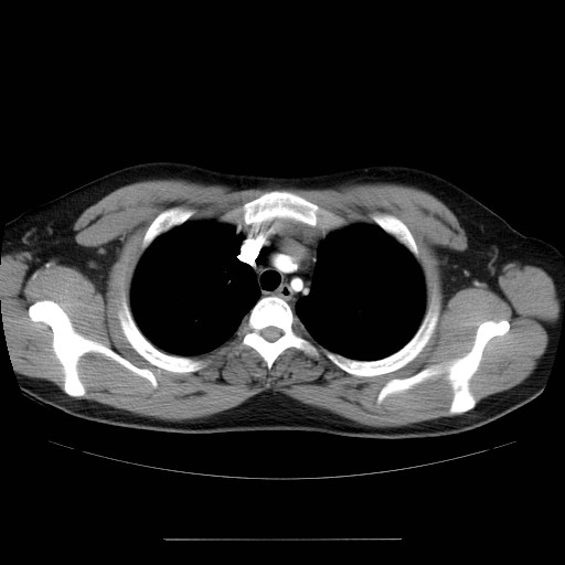 File:Aortic arch stent (Radiopaedia 30030-30595 D 7).jpg