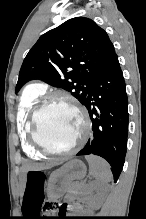 Aortic coarctation with aneurysm (Radiopaedia 74818-85828 B 115).jpg