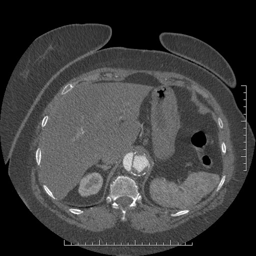 Aortic dissection- Stanford A (Radiopaedia 35729-37268 B 31).jpg