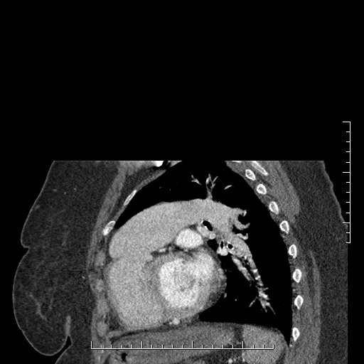 File:Aortic dissection- Stanford A (Radiopaedia 35729-37268 D 3).jpg