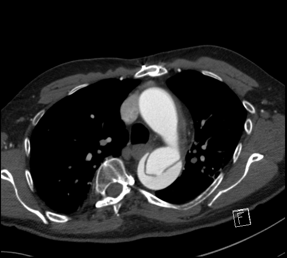 Aortic dissection (CTPA) (Radiopaedia 75506-86750 A 32).jpg