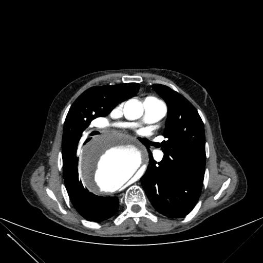Aortic dissection (Radiopaedia 27466-27665 C+ arterial phase 124).jpg