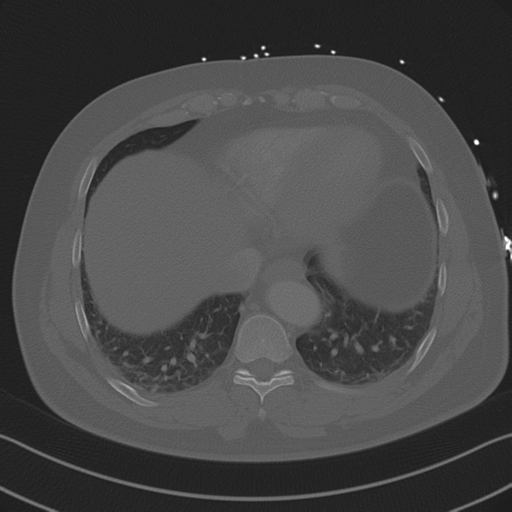 Aortic dissection (Radiopaedia 50763-56234 Axial bone window 79).png