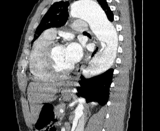 Aortic dissection - Stanford A -DeBakey I (Radiopaedia 28339-28587 C 52).jpg