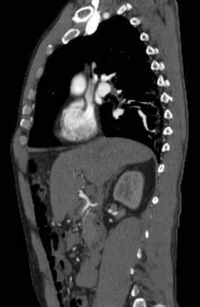 File:Aortic dissection - Stanford type B (Radiopaedia 73648-84437 C 97).jpg