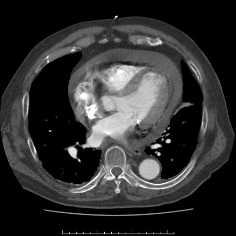 File:Aortic dissection with rupture into the pericardial sac (Radiopaedia 23726-23879 C+ arterial phase 6).jpg