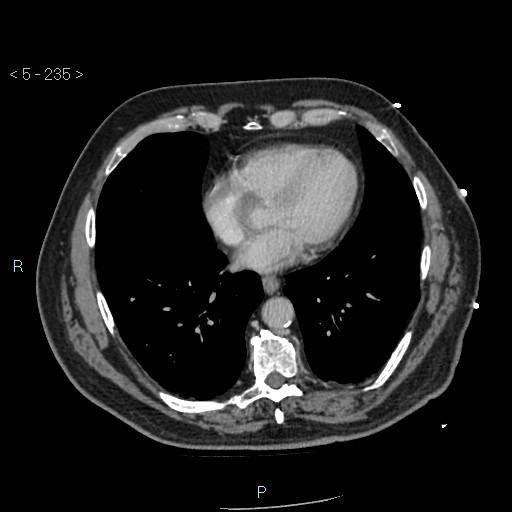 Aortic intramural hematoma (Radiopaedia 48463-53380 C 105).jpg