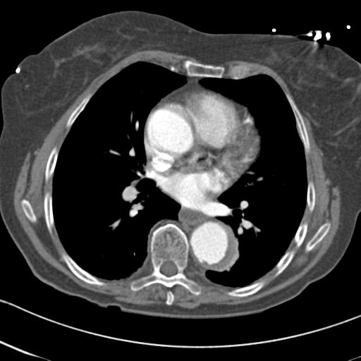 Aortic intramural hematoma from penetrating atherosclerotic ulcer (Radiopaedia 31137-31836 A 45).jpg