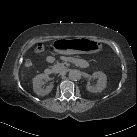 Aortic intramural hematoma with dissection and intramural blood pool (Radiopaedia 77373-89491 Axial non-contrast 112).jpg