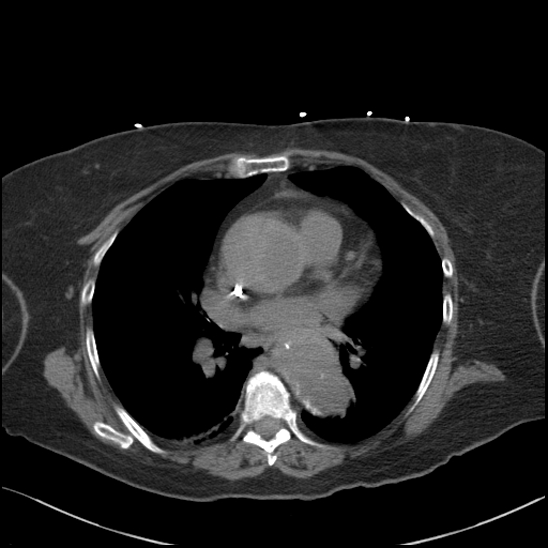 Aortic intramural hematoma with dissection and intramural blood pool (Radiopaedia 77373-89491 Axial non-contrast 52).jpg