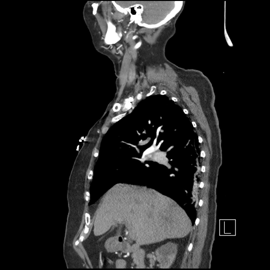 File:Aortic intramural hematoma with dissection and intramural blood pool (Radiopaedia 77373-89491 D 28).jpg