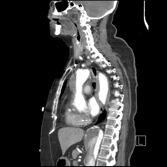Aortic intramural hematoma with dissection and intramural blood pool (Radiopaedia 77373-89491 D 47).jpg