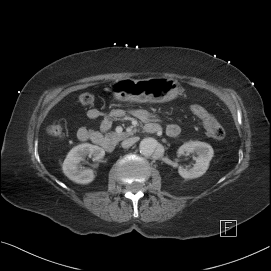 File:Aortic intramural hematoma with dissection and intramural blood pool (Radiopaedia 77373-89491 E 30).jpg