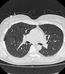 File:Aortic valve endocarditis (Radiopaedia 87209-103485 Axial lung window 47).jpg
