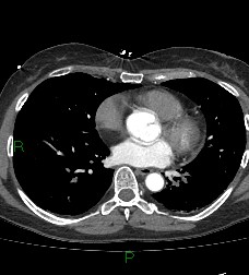 File:Aortic valve endocarditis (Radiopaedia 87209-103485 C 56).jpg