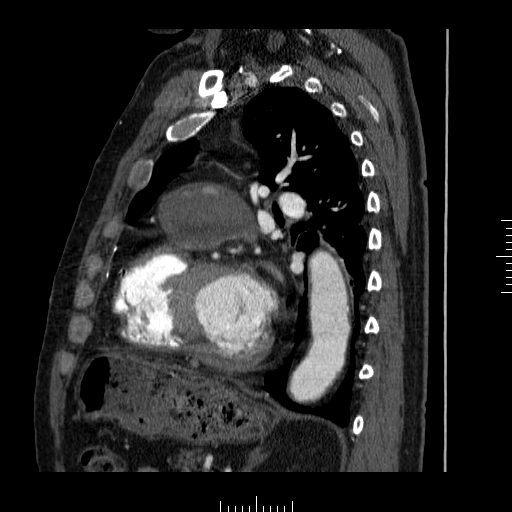 File:Aorto-coronary bypass graft aneurysms (Radiopaedia 40562-43157 C 27).png