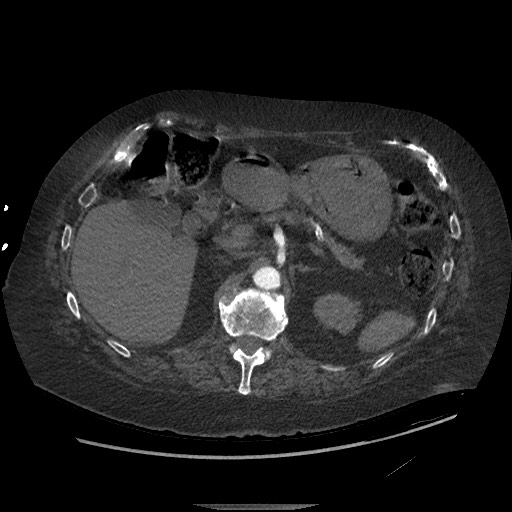Aortoesophageal fistula with endovascular repair (Radiopaedia 73781-84592 Axial C+ CTPA 194).jpg