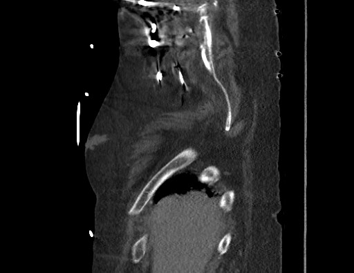 Aortoesophageal fistula with endovascular repair (Radiopaedia 73781-84592 Sagittal C+ CTPA 6).jpg