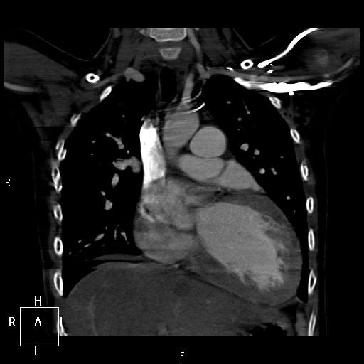 File:Aortopulmonary septal defect (Radiopaedia 41990-45013 Coronal C+ CTPA 23).jpg