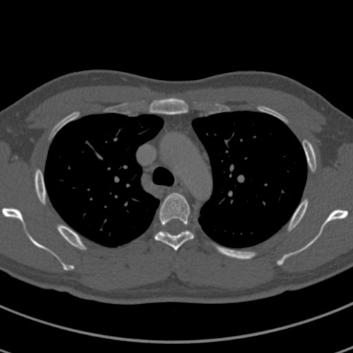 Apical lung mass mimic - neurogenic tumor (Radiopaedia 59918-67521 Axial bone window 26).jpg