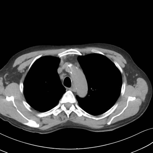 Apical pulmonary metastasis (Radiopaedia 46338-50754 B 19).png