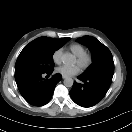 Apical pulmonary metastasis (Radiopaedia 46338-50754 B 38).png