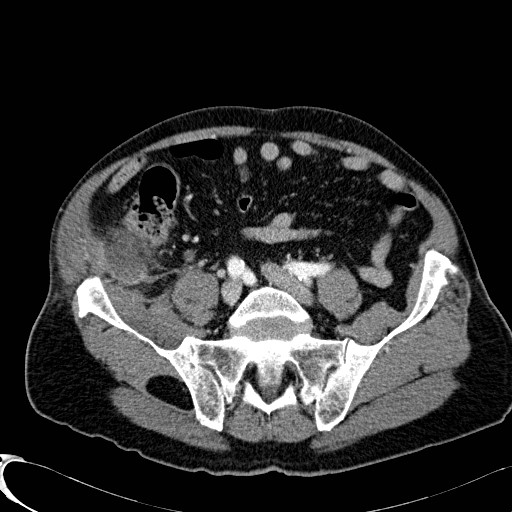 File:Appendiceal adenocarcinoma complicated by retroperitoneal abscess (Radiopaedia 58007-65039 B 100).jpg