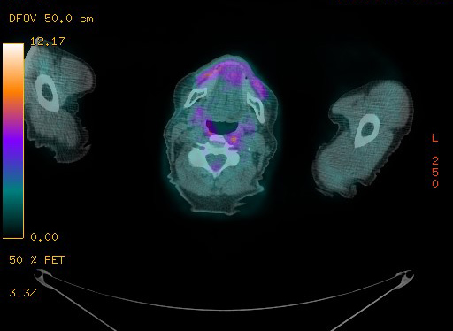 Appendiceal adenocarcinoma complicated by retroperitoneal abscess (Radiopaedia 58007-65041 Axial PET-CT 10).jpg