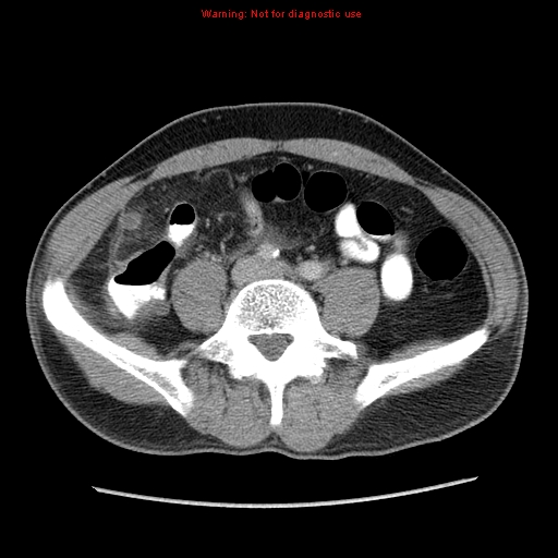 File:Appendicitis and renal cell carcinoma (Radiopaedia 17063-16760 A 38).jpg