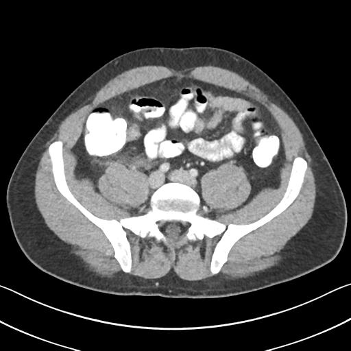 Appendicitis with cecal bar sign (Radiopaedia 31878-32830 B 56).jpg
