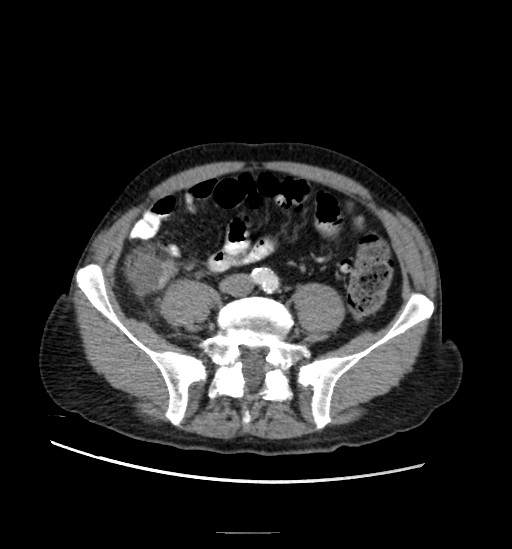 Appendicitis with localized perforation and abscess formation (Radiopaedia 49035-54130 A 61).jpg