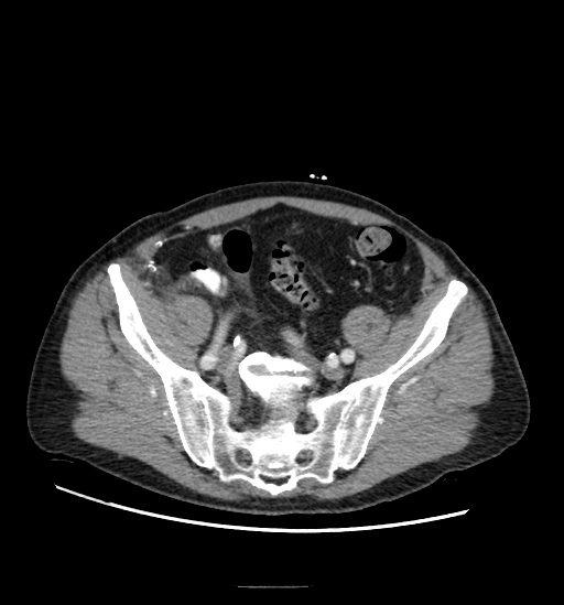 Appendicitis with localized perforation and abscess formation (Radiopaedia 49035-54130 A 69).jpg