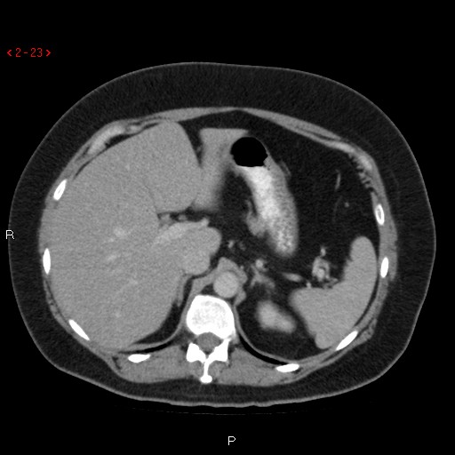 Appendicitis with microperforation- promontoric type (Radiopaedia 27268-27442 C 11).jpg