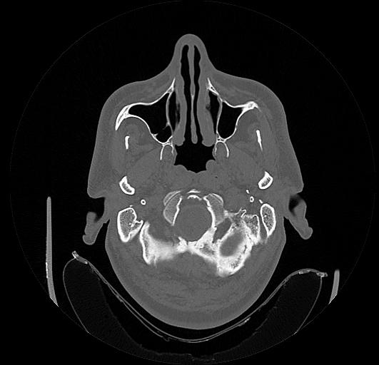 File:Arcuate foramen (Radiopaedia 89833-106944 Axial bone window 3).jpg