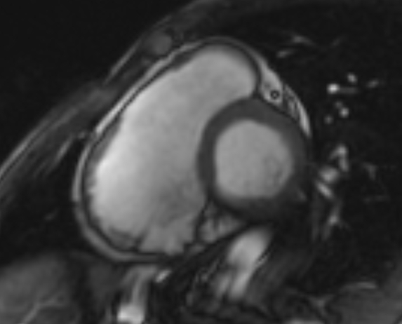 Arrhythmogenic right ventricular cardiomyopathy (Radiopaedia 69564-79464 short axis cine 204).jpg