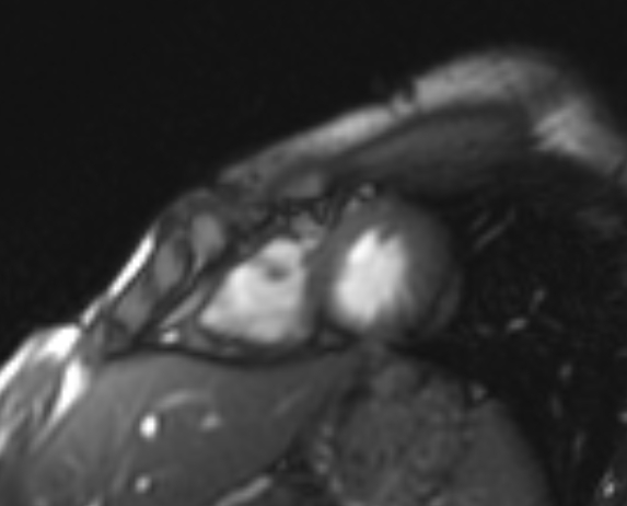 Arrhythmogenic right ventricular cardiomyopathy (Radiopaedia 69564-79464 short axis cine 44).jpg