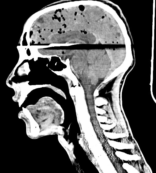 Arrow injury to the brain (Radiopaedia 72101-82607 H 34).jpg
