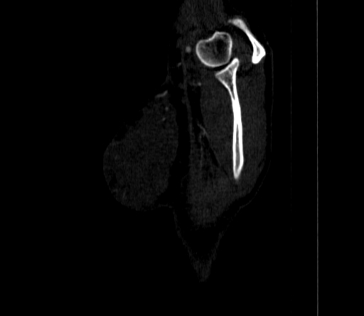 Arteria lusoria (Radiopaedia 88528-105192 C 12).jpg