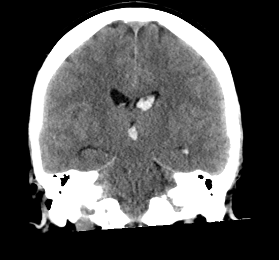 File:Arteriovenous malformation (cerebral) (Radiopaedia 40070-42579 Coronal non-contrast 22).png