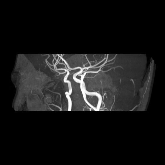 File:Artery of Percheron infarct (Radiopaedia 40966-43676 G 45).jpg