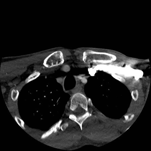 File:Artery of Percheron infarct (Radiopaedia 48088-52894 A 19).jpg