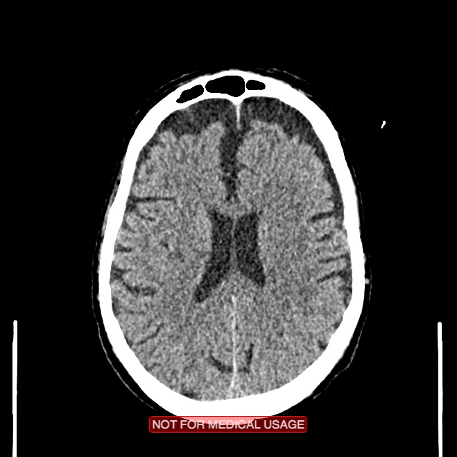 Artery of Percheron infarction (Radiopaedia 28679-28967 Axial non-contrast 75).jpg