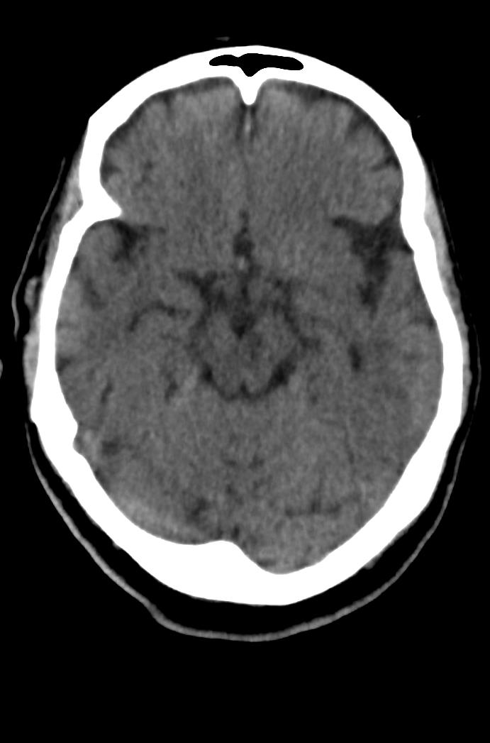 Artery of Percheron infarction (Radiopaedia 80613-94202 Axial non-contrast 77).jpg