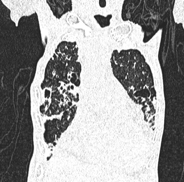 Aspergilloma- with Monod sign (Radiopaedia 44737-48532 Coronal lung window 166).jpg