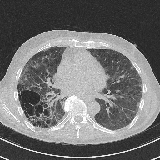 Aspergilloma on background pulmonary fibrosis (Radiopaedia 60942-68757 A 33).jpg